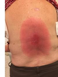Lyme rash on back